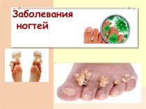 Презентация к занятию по теме ЗОЖ Симптомы и лечение грибка ногтя на ногах