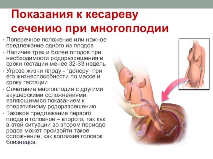 Показания к кесареву сечению при многоплодииПоперечное положение или ножное предлежание одного из