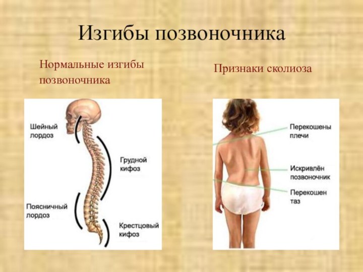 Изгибы позвоночника Нормальные изгибыпозвоночникаПризнаки сколиоза