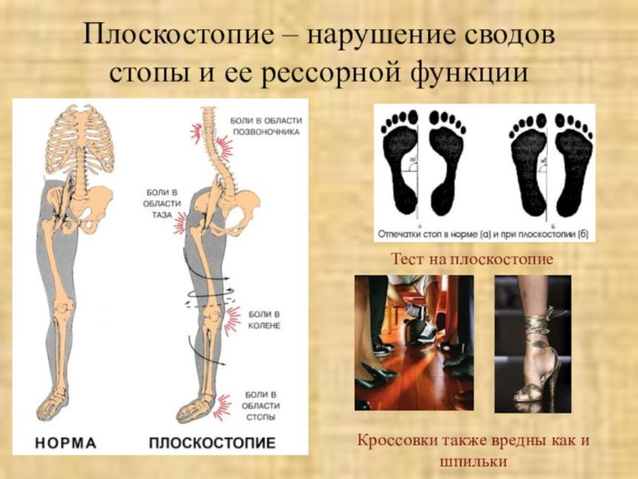 Плоскостопие – нарушение сводов стопы и ее рессорной функцииКроссовки также вредны как и шпилькиТест на плоскостопие