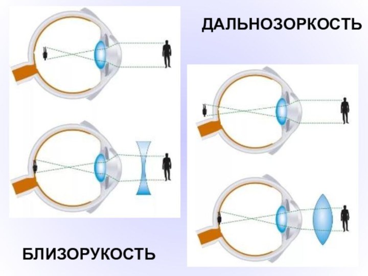 БЛИЗОРУКОСТЬДАЛЬНОЗОРКОСТЬ