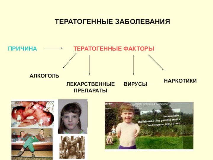 ТЕРАТОГЕННЫЕ ЗАБОЛЕВАНИЯПРИЧИНАТЕРАТОГЕННЫЕ ФАКТОРЫАЛКОГОЛЬЛЕКАРСТВЕННЫЕПРЕПАРАТЫВИРУСЫНАРКОТИКИ