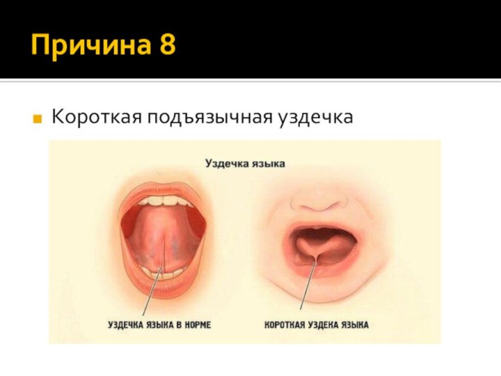 Причина 8Короткая подъязычная уздечка