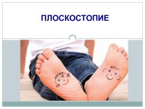 Родительское собрание Плоскостопие презентация по теме