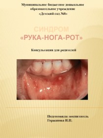 Консультация для родителей Синдром рука-нога-рот презентация