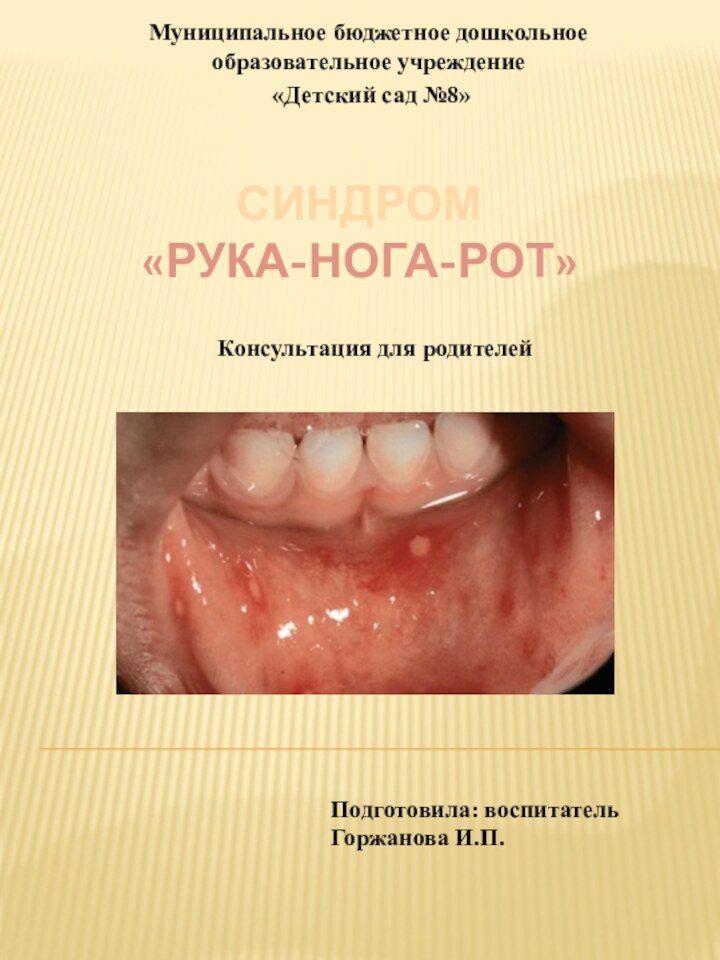 СИНДРОМ «Рука-нога-рот»Муниципальное бюджетное дошкольное образовательное учреждение «Детский сад №8»Консультация для родителейПодготовила: воспитатель Горжанова И.П.